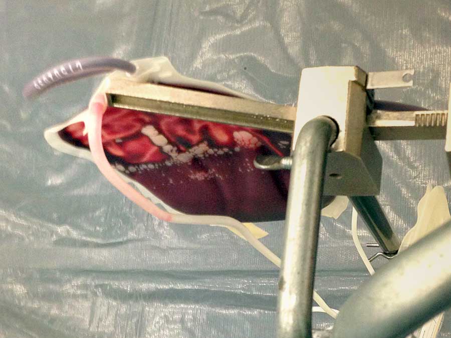 Filling my blood bag